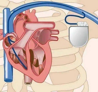 MC1AVR1 美敦力經(jīng)導(dǎo)管植入式無(wú)導(dǎo)線起搏系統(tǒng)