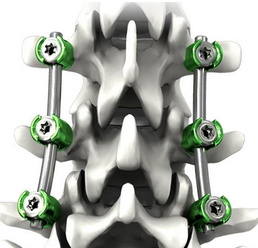 美敦力脊柱內固定系統組件