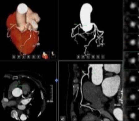 冠脈功能影像分析系統(tǒng) qfr-a